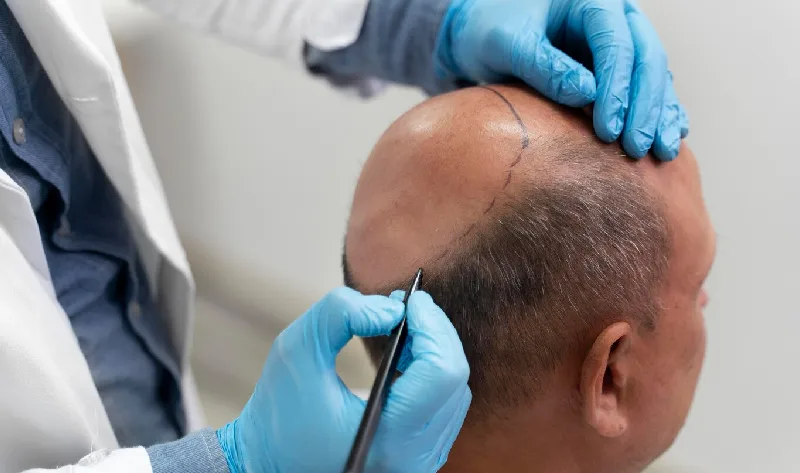 DHI Hair Transplant in Dubai: The Ultimate 2025 Guide to Cost, Benefits & Procedure