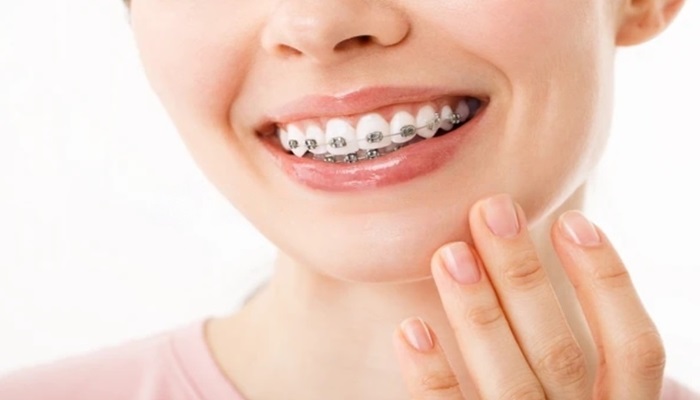 Are Adult Braces the Right Choice for Your Smile Correction?