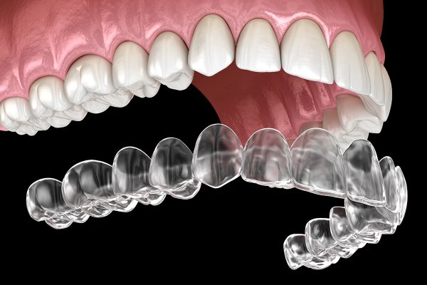 Understanding the Cost and Process of Invisalign: A Complete Guide