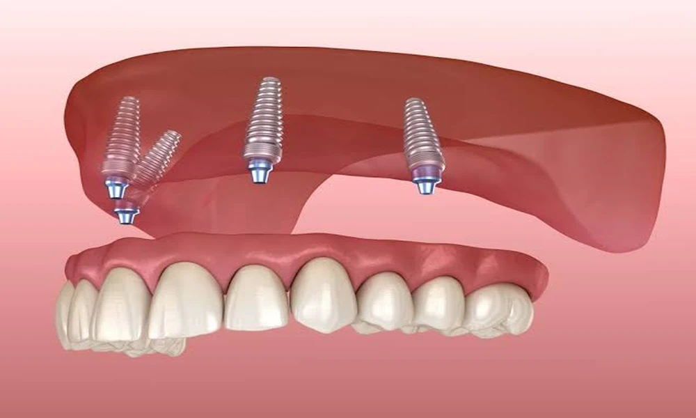 HOW TO COMPARE DENTAL IMPLANT COSTS BEFORE TREATMENT?